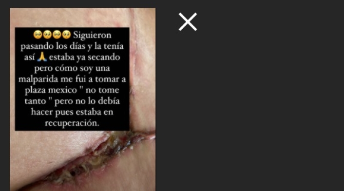 Cirugía a Yina Calderón