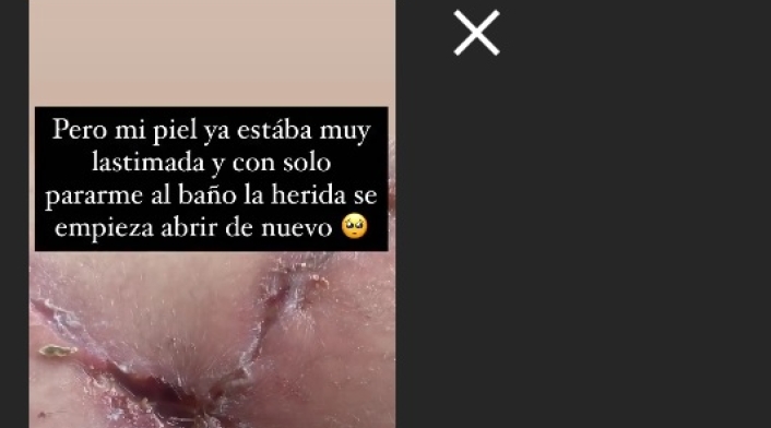Cirugía a Yina Calderón