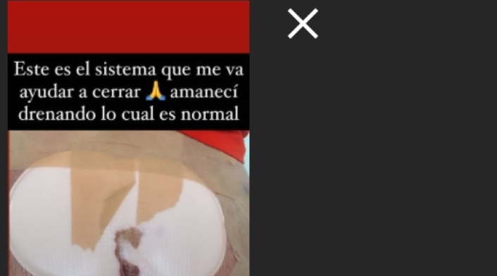 Cirugía a Yina Calderón