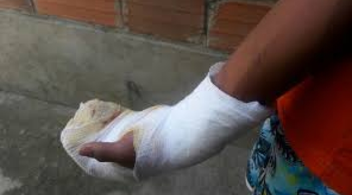 Quemados con pólvora Quemados con pólvora
