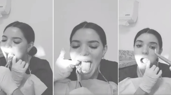Dentista se saca las cordales sin ayuda