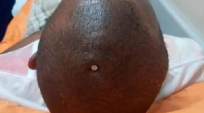 Hombre clavó una puntilla en su cabeza