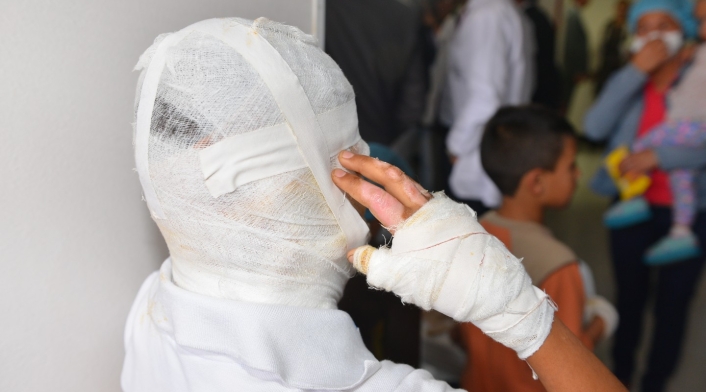 Los quemados con pólvora en Colombia ya llegan a los 644 Alarmante cifras de quemados en Boyacá