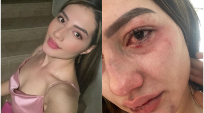 Joven denuncia caso de maltrato físico por parte de su exnovio