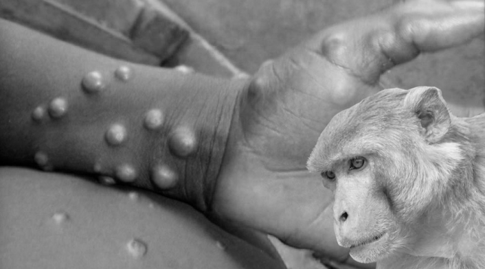 Viruela del mono, virus que proviene de un simio Viruela del mono