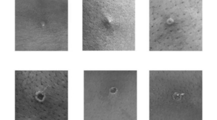 Infectados por Viruela del mono