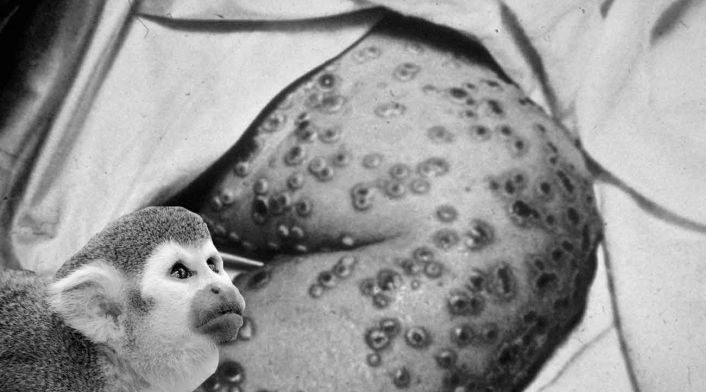 Caso de viruela del mono Caso de viruela del mono