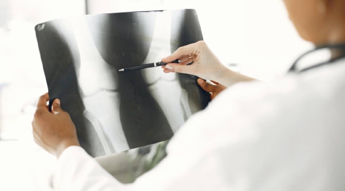 Osteoporosis Osteoporosis