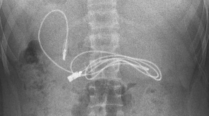 Joven resultó con cable USB en su interior Joven resultó con cable USB en su interior