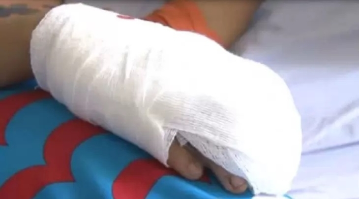 Niño quemado en Antioquia