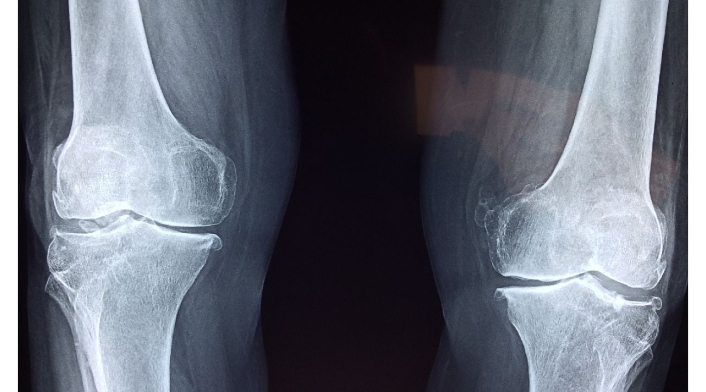 Radiografía de rayos X de unas rodillas