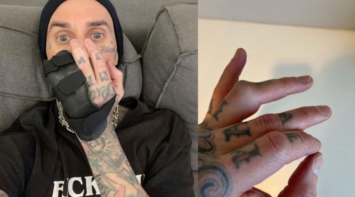 Travis Barker y su lesión en la mano