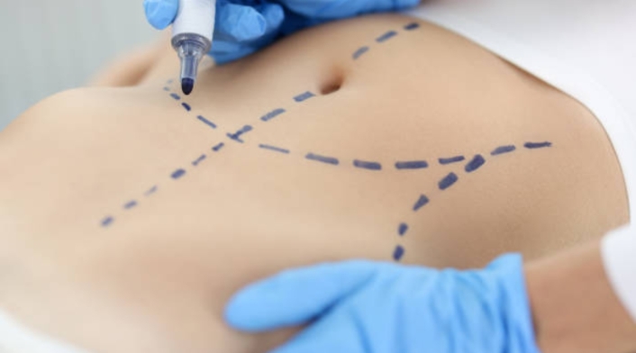 Mujer pidió dinero para tratar supuesto cáncer y terminó haciéndose una lipo Liposucción