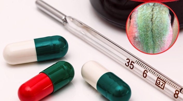 A hombre se le puso la lengua verde y llena de pelos A hombre se le puso la lengua verde y llena de pelos: todo por tomar un medicamento