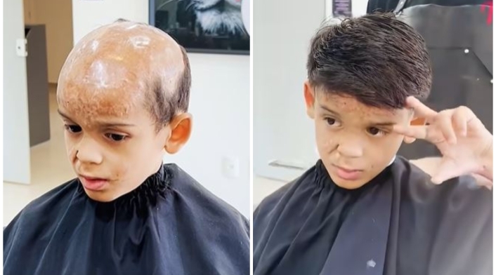 Niño calvo por quemadas ahora tiene pelo: emotivo video