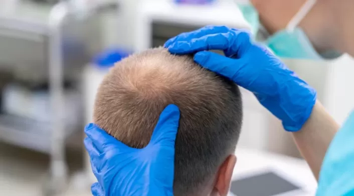 Implantes capilares