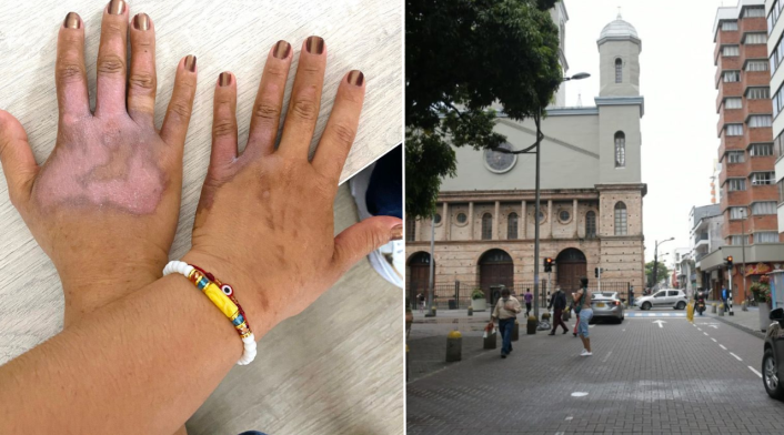 Mujer victima de quemaduras con acido en Pereira