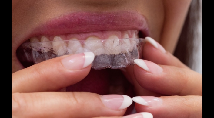 Imagen de referencia sobre alineadores dentales Imagen de referencia sobre alineadores dentales