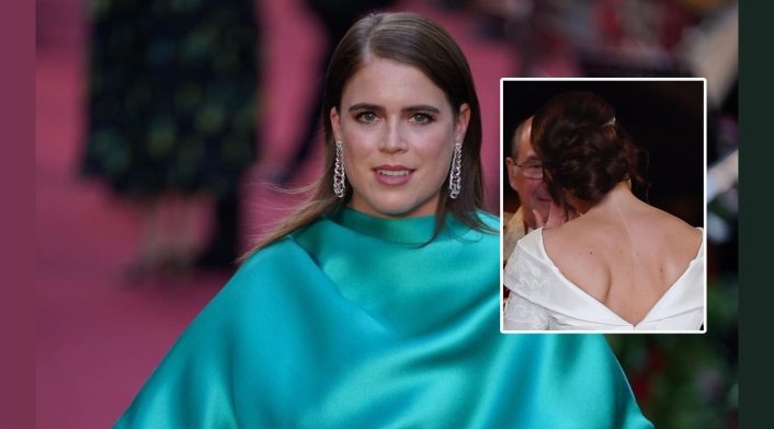 Princesa Eugenia La verdad detrás de la gran cicatriz de la princesa Eugenia