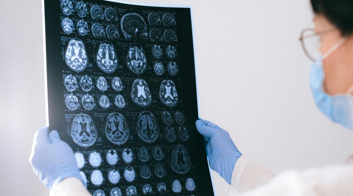 Alzheimer Alzheimer