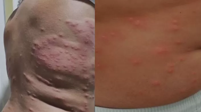 Autoridades de Santa Marta descartan contaminación del mar como causa de brotes en la piel reportados por bañistas