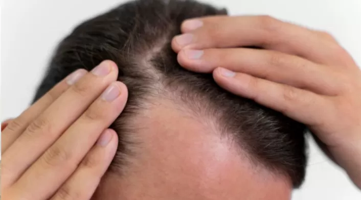 Caída del pelo en hombres Caída del pelo en hombres