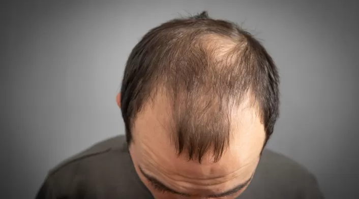 Alopecia Alopecia