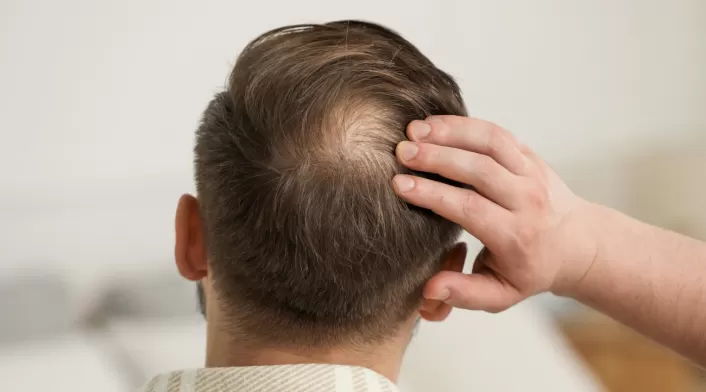 Alopecia Alopecia