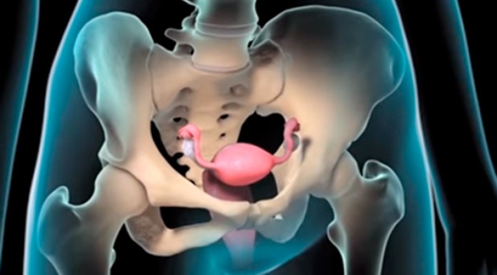 Endometriosis.jpg