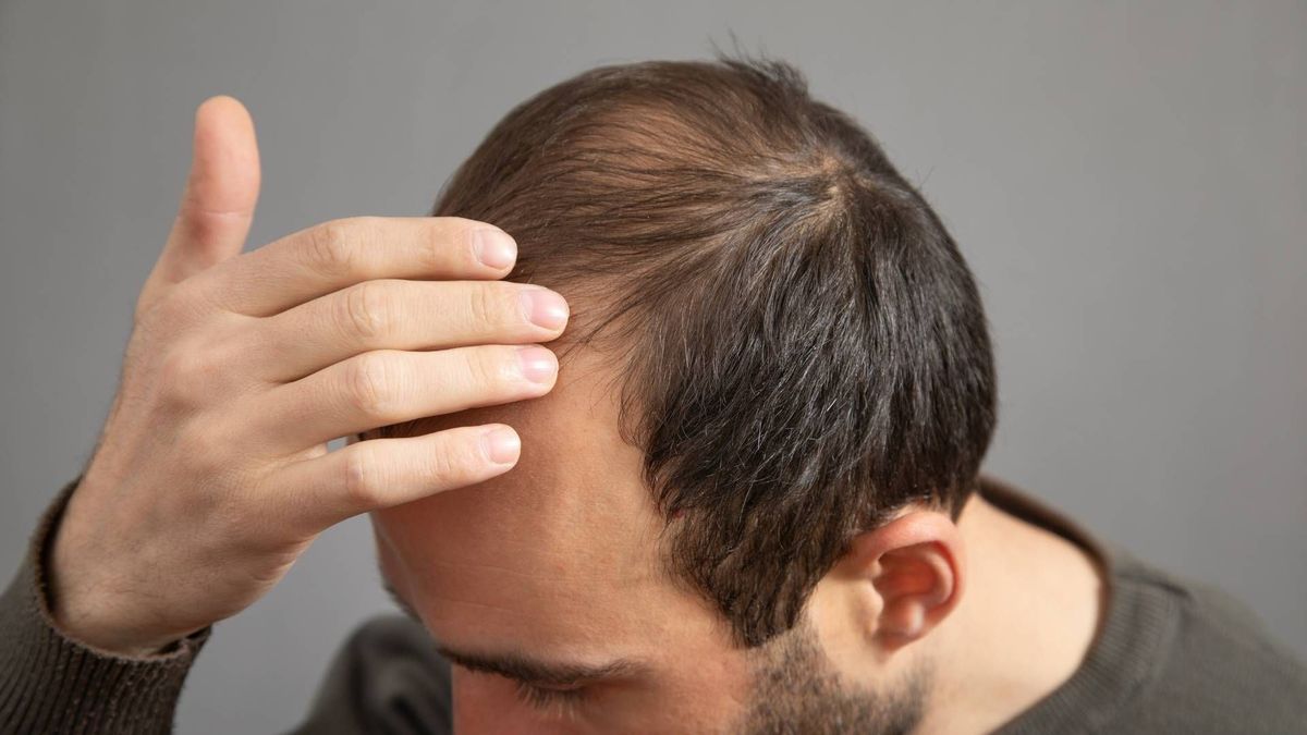 La coronilla suele ser el primer punto donde se nota la caída del cabello, un patrón ligado a la genética y las hormonas.