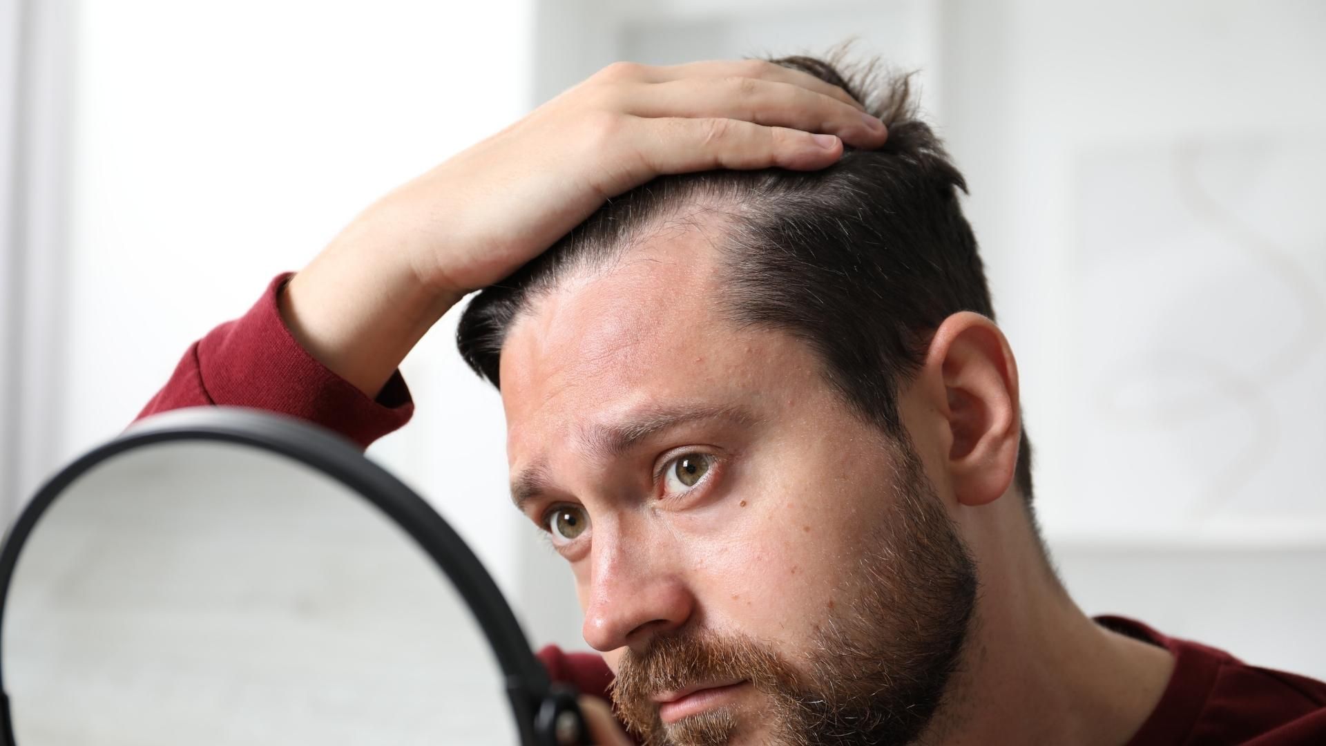 La pérdida del cabello no ocurre al azar: la parte superior de la cabeza es la más afectada en muchos casos.