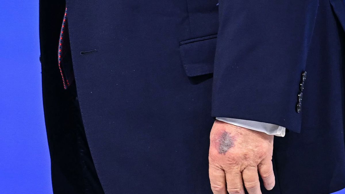 Presidente Donald Trump con un morado en su mano en Davos