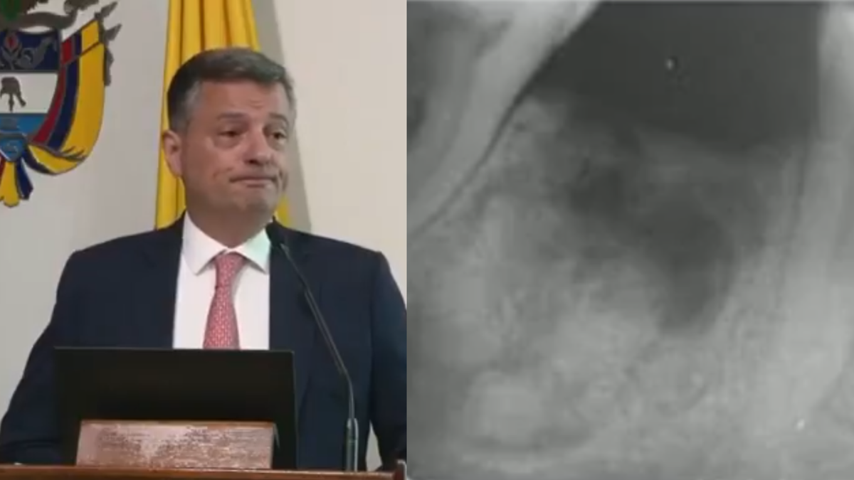 Médico de la Academia Colombiana de Medicina, Carlos López, expone caso de tumor de una paciente