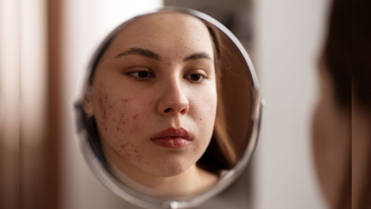 El tercer paso es la hidratación y el uso de protector solar. Aunque la piel con acné puede ser grasa, necesita mantener su barrera en buen estado.