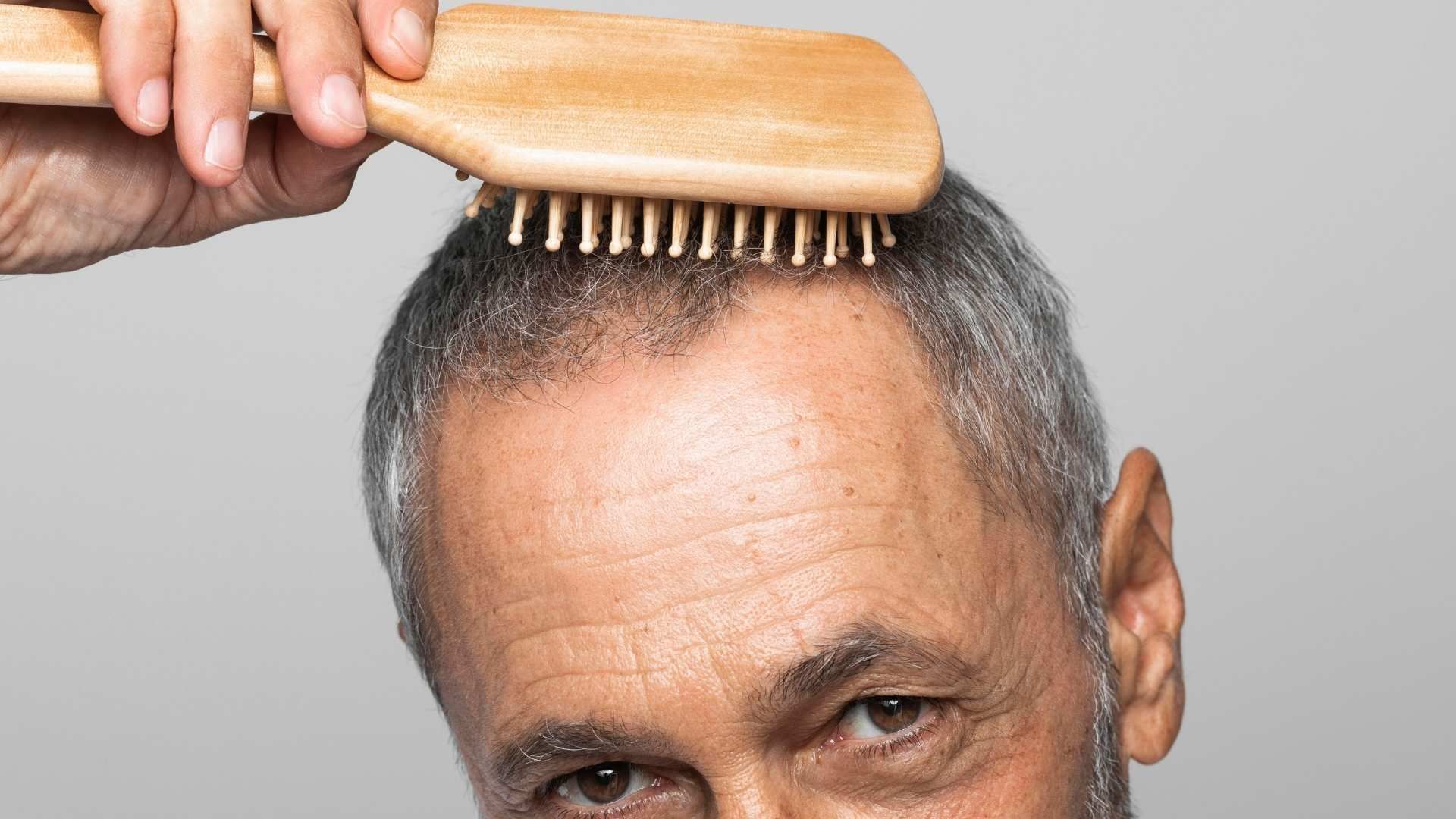 Factores como la genética y la testosterona influyen directamente en la pérdida de cabello masculina.