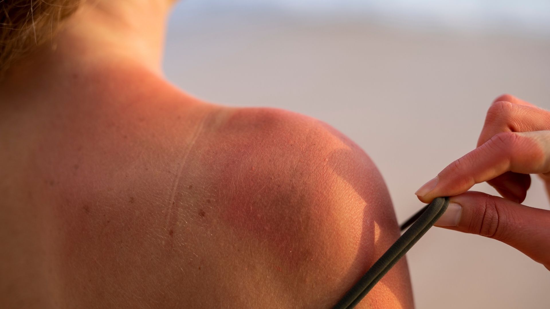 El Fenómeno de El Niño eleva la radiación UV en Colombia y con ella el riesgo de cáncer de piel.
