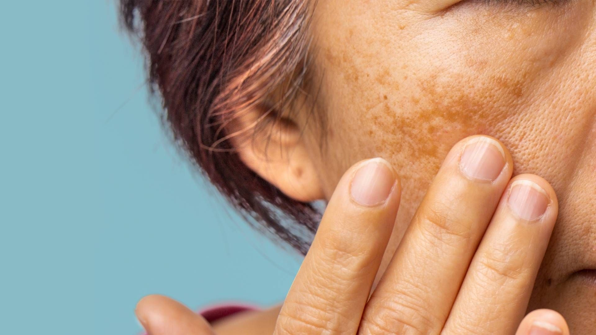 Sin protector solar, el Fenómeno de El Niño puede provocar quemaduras, manchas y hasta melanoma.