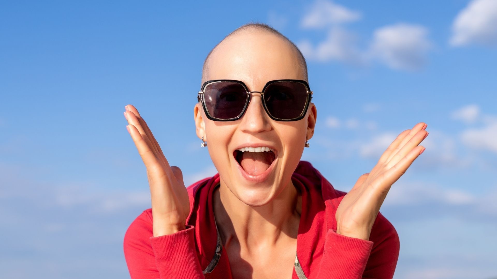 El protector solar debe aplicarse también en el cuero cabelludo cuando existe calvicie o alopecia, según especialistas.