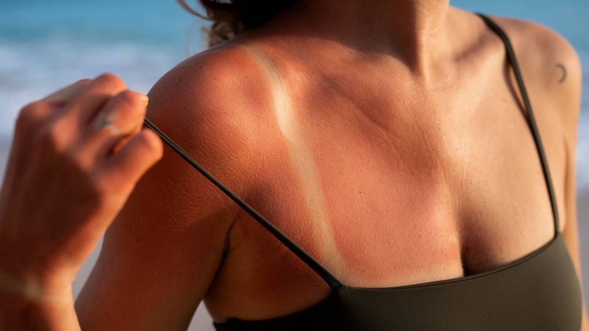 La exposición al sol, la sal y el cloro puede afectar la piel y el cabello durante las vacaciones.