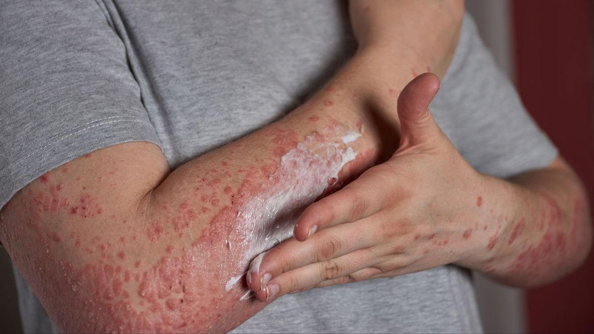 herpes zoster colombia cuanto cuesta vacuna edad recomendada